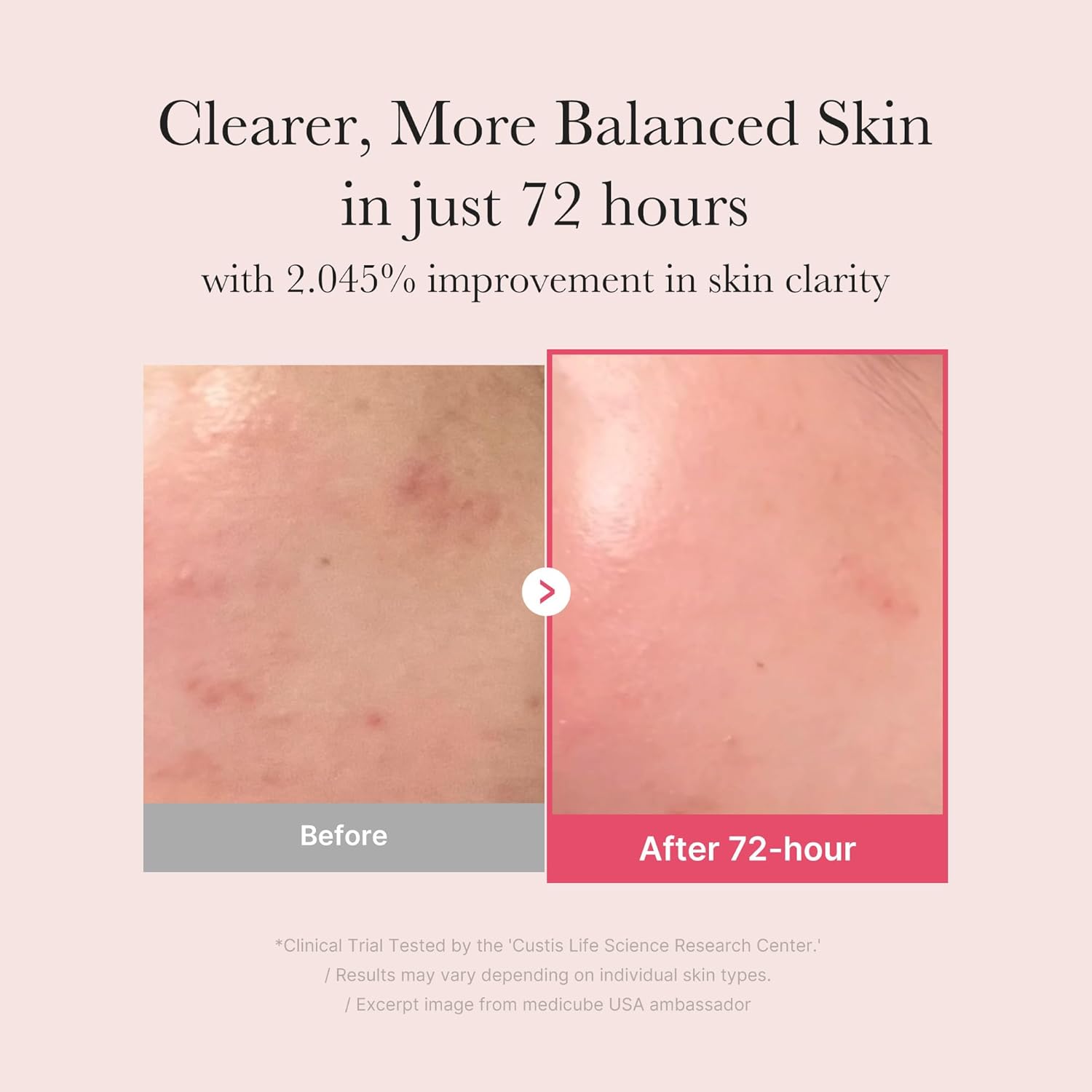 2% arbutin layered with txa and niacinamide for a triple-brightening system