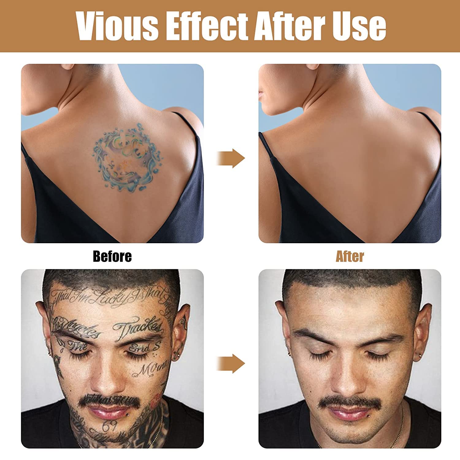 Tattoo_Cover_Up_Makeup_Waterproof,_Body_&_Leg_Scar_Concealer,_Suitable_for_Scars,_Dark_Spots,_Vitiligo,_2_Colors