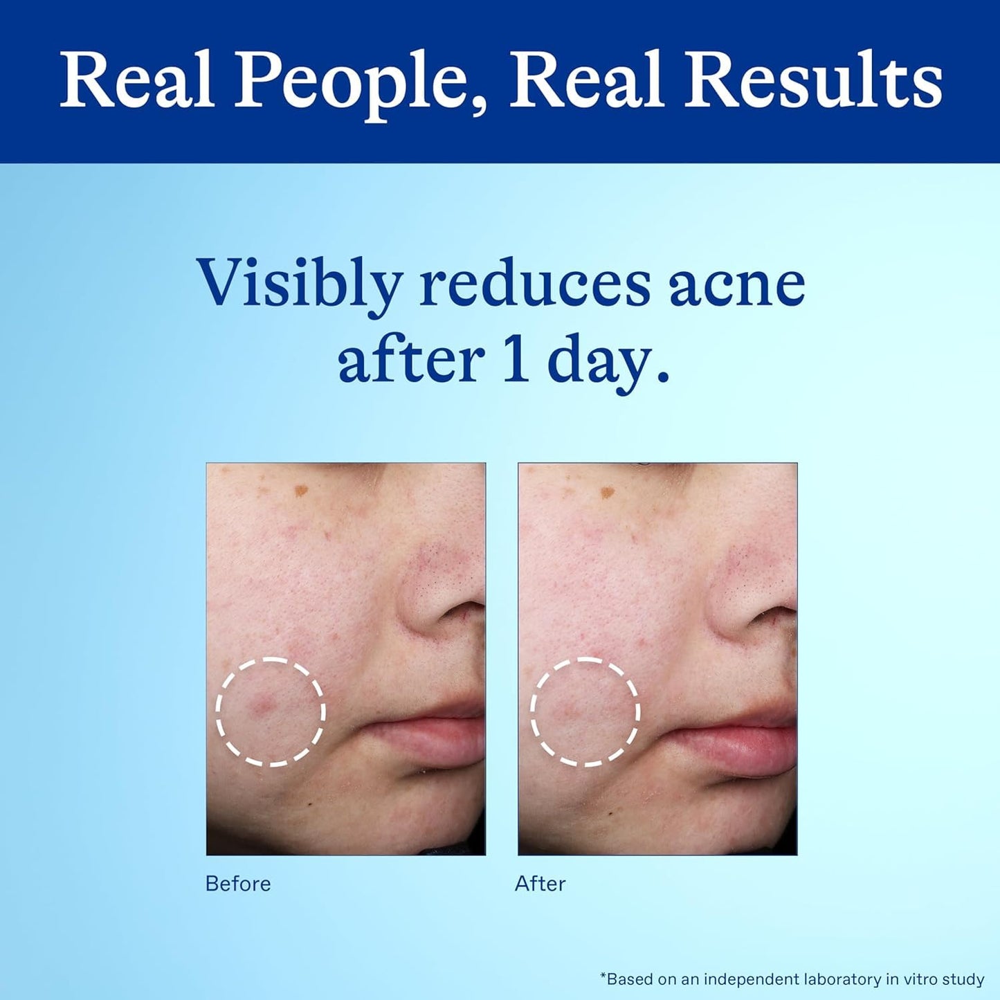 Differin_Acne_Spot_Treatment_with_10%_Benzoyl_Peroxide,_Maximum_Strength_OTC_Acne_Treatment,_Fast_Acting_Spot_Treatment_for_Face,_1_oz