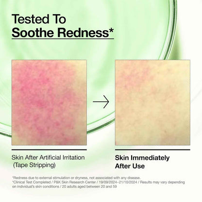 Anua Azelaic Acid 10 Hyaluron Redness Soothing Serum, Facial Serum for Blemish-Prone & Oily-Prone Skin, Lightweight & Hydrating Blemish Care, Hyaluronic Acid, Korean Skincare, 1.01 fl oz.