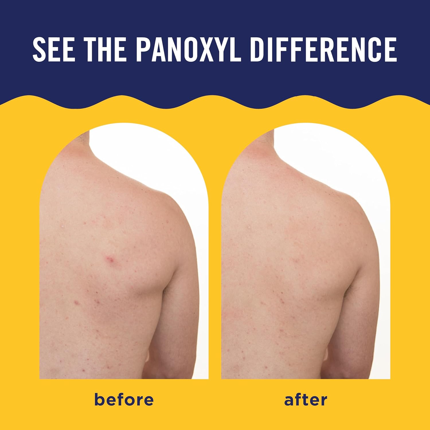 PanOxyl_Acne_Banishing_Body_Spray_with_2%_Salicylic_Acid,_Pimple_Treatment_Spray_to_Clear_Stubborn_Breakouts,_360-Degree_Spray_Nozzle,_Skin-Brightening_Niacinamide,_Vitamin_C,_Witch_Hazel,_Aloe,_6_Oz