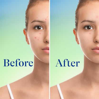 Differin_Acne_Face_Wash_with_10%_Benzoyl_Peroxide,_Maximum_Strength_OTC_Acne_Foaming_Cleanser,_Fast_Acting_Acne_Treatment_for_Face_and_Body,_5_oz.