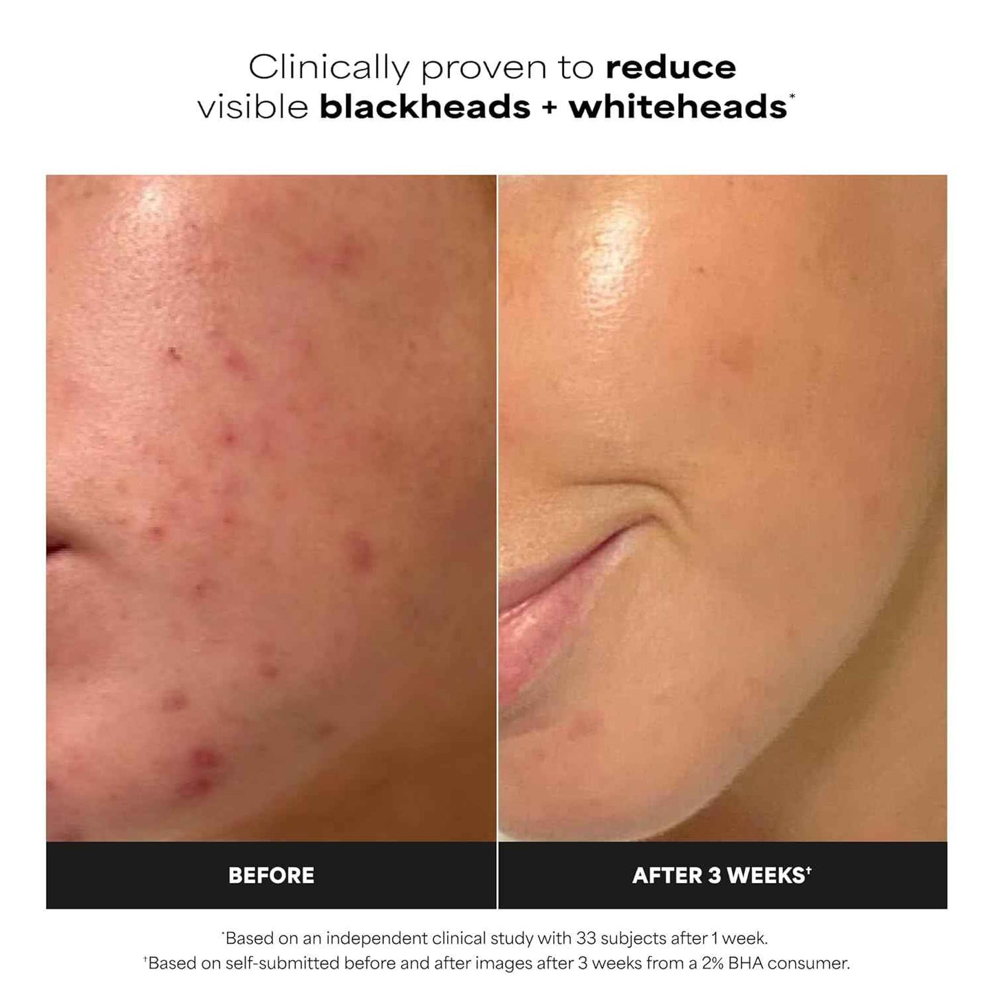 Paula's Choice SKIN PERFECTING 2% BHA Salicylic Acid Exfoliating Pads - Facial Exfoliant Pads for Blackheads, Enlarged Pores, Wrinkles & Fine Lines