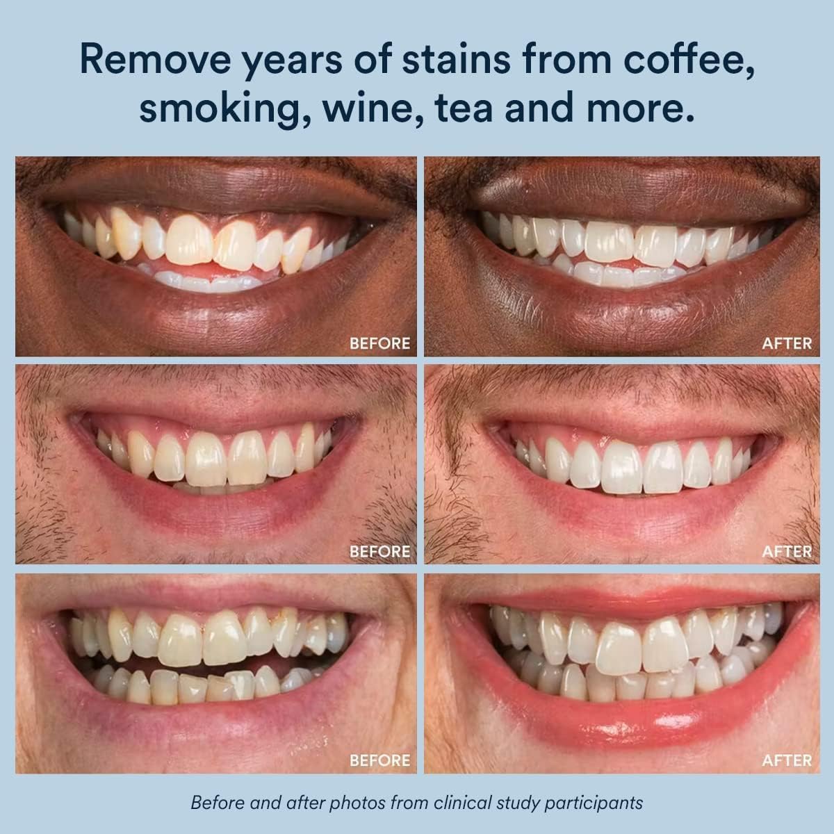 Sensitive_Teeth_Whitening_Strips_–_14_Treatments_(28_Strips),_8%_Hydrogen_Peroxide_with_Nano_Hydroxyapatite,_Low_Sensitivity_At-Home_Whitening,_Mint_–_Auraglow
