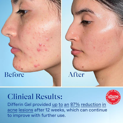 Differin_Acne_Treatment_Gel,_30_Day_Supply,_Retinoid_Treatment_for_Face_with_0.1%_Adapalene,_Gentle_Skin_Care_for_Acne_Prone_Sensitive_Skin,_15g_Pump_(Packaging_May_Vary)