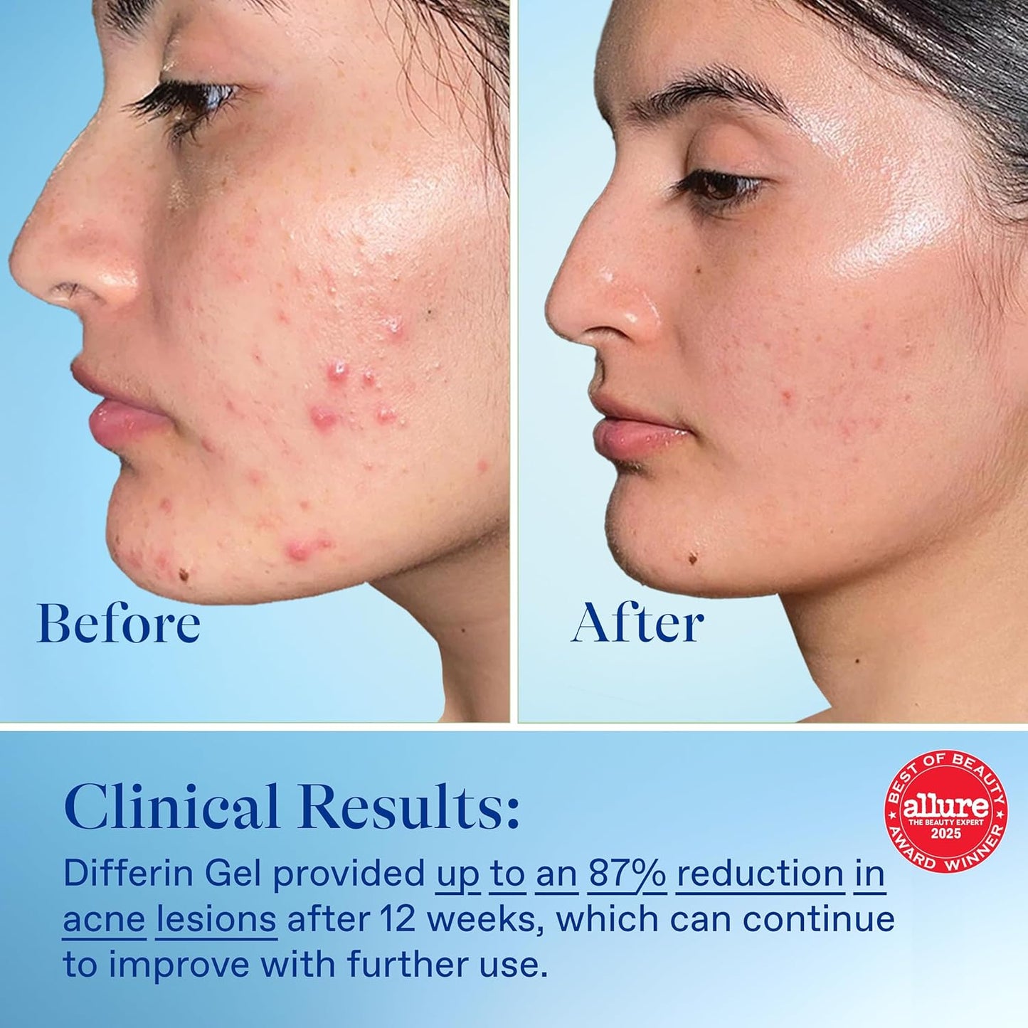 Differin_Acne_Treatment_Gel,_60_Day_Supply,_Retinoid_Treatment_for_Face_with_0.1%_Adapalene,_Gentle_Skin_Care_for_Acne_Prone_Sensitive_Skin,_15g_Tube_(Pack_of_2)_(Packaging_May_Vary)