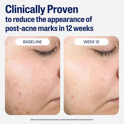CETAPHIL Gentle Clear Repairing Post-Acne Serum, Retinol Alternative, Oil Free Serum for Sensitive Skin, 1 Fl Oz, Bakuchiol, Improves Skin Tone & Post-acne Marks, Dermatologist Recommended Brand