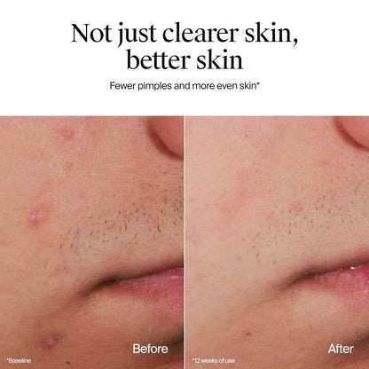 Neutrogena Oil-Free Acne Face Wash, Fragrance Free, Sensitive Skin Facial Cleanser with 2% Salicylic Acid Acne Treatment for Face, 9.1 Fl Oz