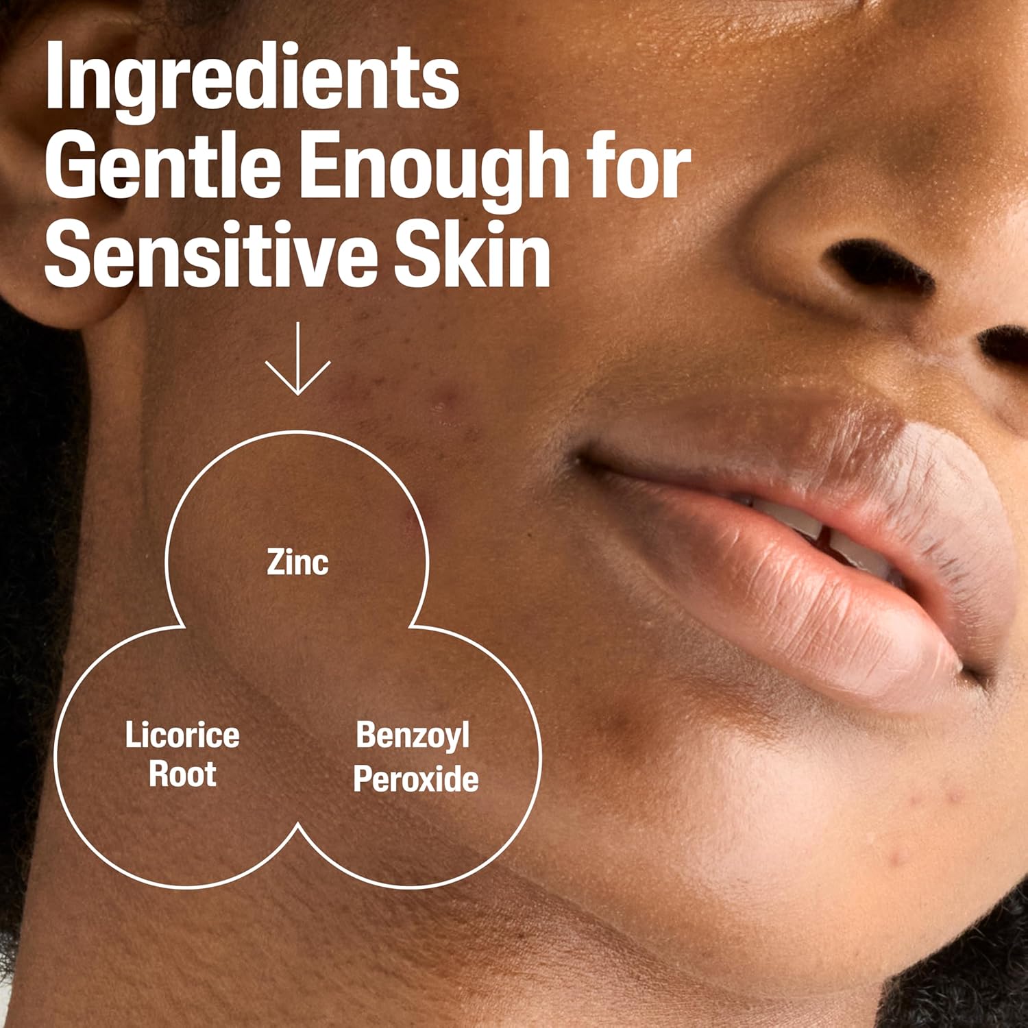 Cetaphil_Gentle_Clear_Complexion-Clearing_BPO_Acne_Cleanser_with_2.6%_Benzoyl_Peroxide,_Creamy_and_Soothing_for_Sensitive_Skin,_Suitable_for_All_Skin_Types,_4.2oz
