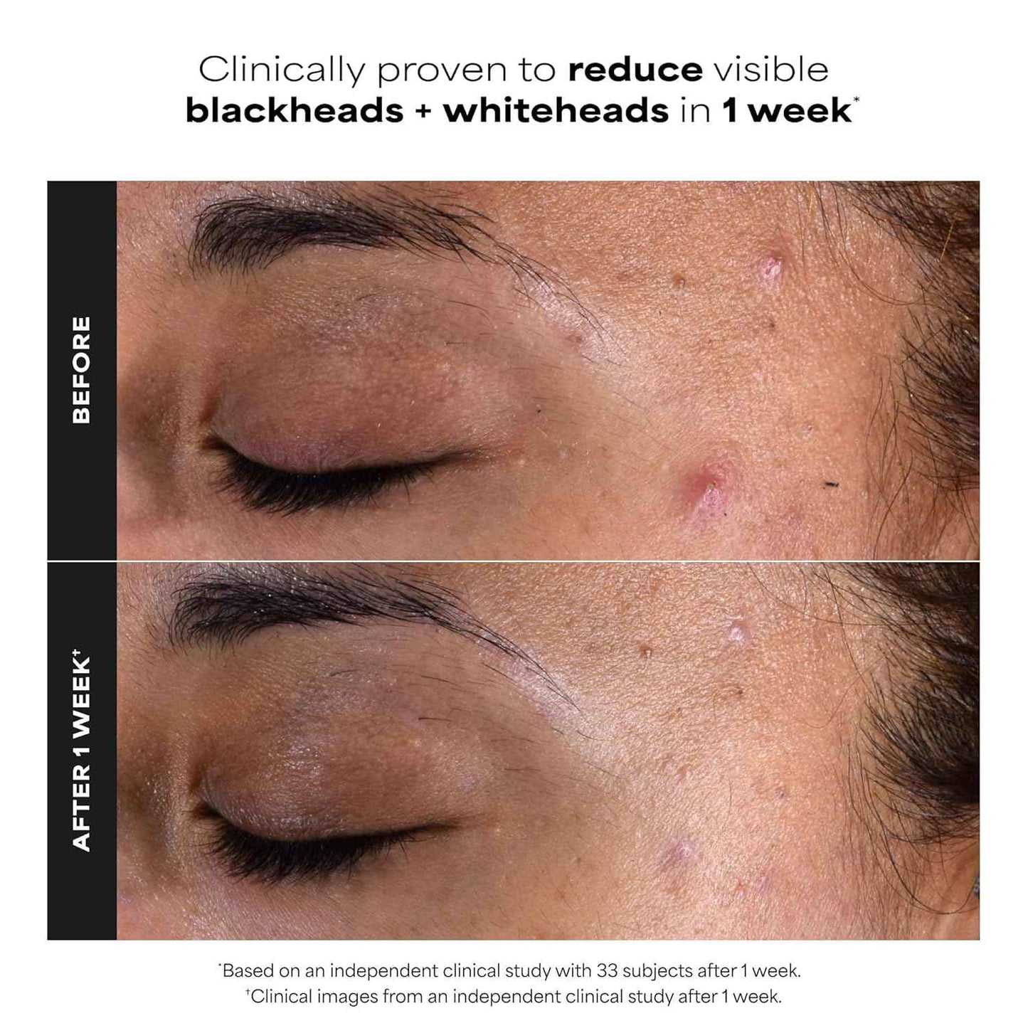 Paula's Choice SKIN PERFECTING 2% BHA Salicylic Acid Exfoliating Pads - Facial Exfoliant Pads for Blackheads, Enlarged Pores, Wrinkles & Fine Lines