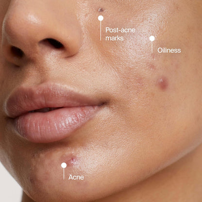 Neutrogena_Evenly_Clear_Acne_Cleansing_Face_Mask_with_3.5%_Benzoyl_Peroxide_Treats_Breakouts_&_Bentonite_Clay,_Purifying_Clay_Mask_Absorbs_Oil_to_Visibly_Improve_the_look_of_Skin,_4.2_fl._oz
