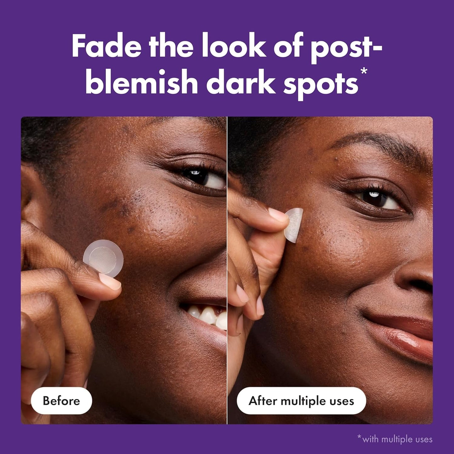 Mighty_Patch_Hero_Cosmetics_Micropoint™_for_Dark_Spots_-_Post-Blemish_Dark_Spot_Patch_with_395_Micropoints,_Dermatologist_Tested_and_Non-irritating_(8_Count)