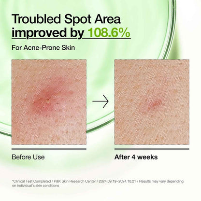 Anua Azelaic Acid 10 Hyaluron Redness Soothing Serum, Facial Serum for Blemish-Prone & Oily-Prone Skin, Lightweight & Hydrating Blemish Care, Hyaluronic Acid, Korean Skincare, 1.01 fl oz.