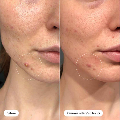 Mighty Patch™ Invisible+ Patch - Daytime Hydrocolloid Acne Pimple Patches for Covering Zits and Blemishes, Ultra Thin Spot Stickers for Face and Skin