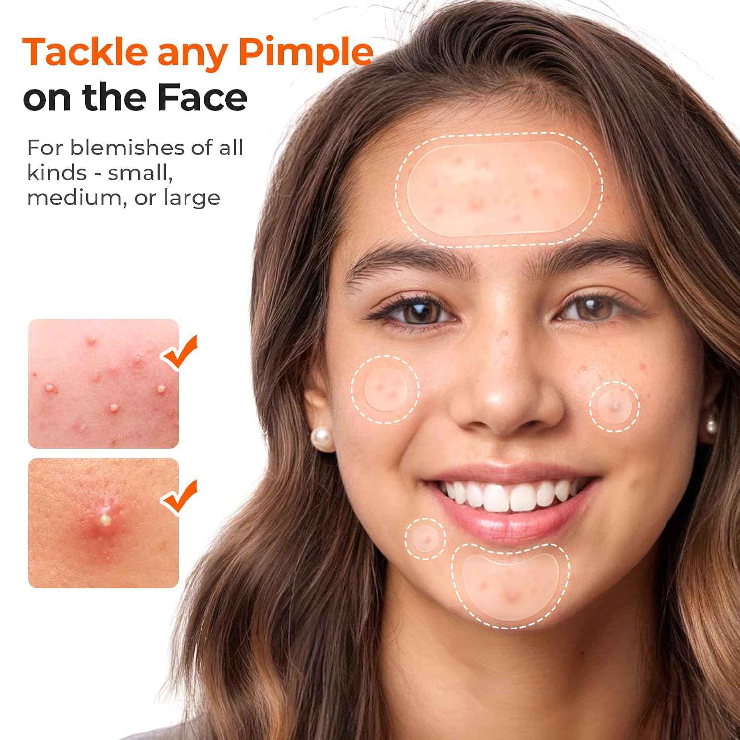 TKTK Hydrocolloid Acne Stickers – Allergy-Friendly Blemish Treatment Safe for Reactive Skin