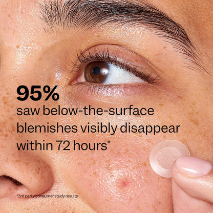 self-dissolving microdarts release ingredients directly into the skin at the blemish site