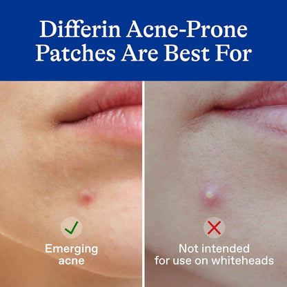 Differin Acne Patches – Clean, Invisible Design for Intentional Skincare Routines